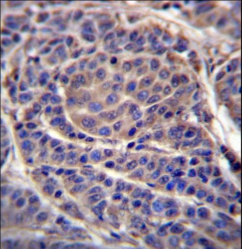 CA6 Antibody immunohistochemistry of formalin-fixed and paraffin-embedded human melanoma followed by peroxidase-conjugated secondary antibody and DAB staining.