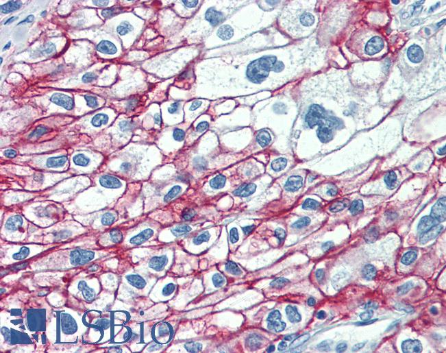 Anti-CA9 / Carbonic Anhydrase IX antibody IHC of human kidney, renal cell carcinoma. Immunohistochemistry of formalin-fixed, paraffin-embedded tissue after heat-induced antigen retrieval. Antibody LS-B273 concentration 0.625 ug/ml.