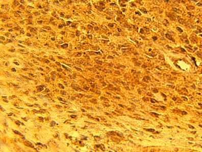 IHC of human melanoma tumor tissue using alpha1G calcium channel antibody (LS-C140729) at 15 ug/ml.