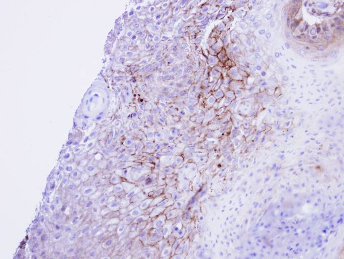 IHC of paraffin-embedded Cal27 xenograft using CACNA1S antibody at 1:100 dilution.