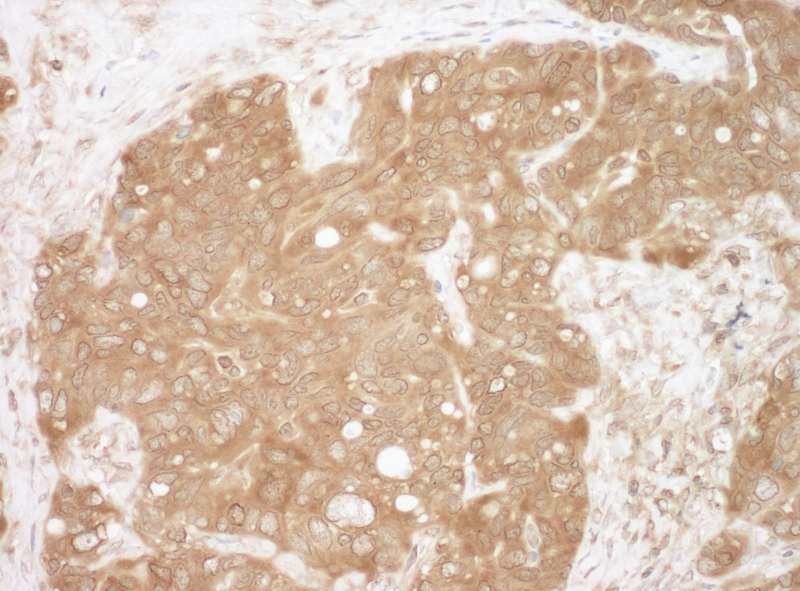 Detection of Human CacyBP by Immunohistochemistry. Sample: FFPE section of human ovarian carcinoma. Antibody: Affinity purified rabbit anti-CacyBP used at a dilution of 1:200 (1 ug/ml). Detection: DAB.