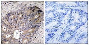 IHC of paraffin-embedded human colon carcinoma tissue, using CAD Antibody. The sample on the right was incubated with synthetic peptide.