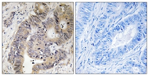 IHC of paraffin-embedded human colon carcinoma, using CAD (Phospho-Thr456) Antibody. The sample on the right was incubated with synthetic peptide.