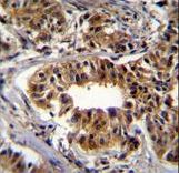 CAD Antibody immunohistochemistry of formalin-fixed and paraffin-embedded human breast carcinoma followed by peroxidase-conjugated secondary antibody and DAB staining.