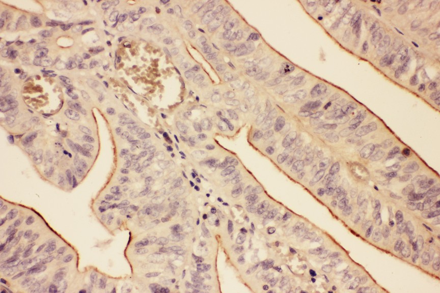 Actin antibody IHC-paraffin: Human Intestinal Cancer Tissue.