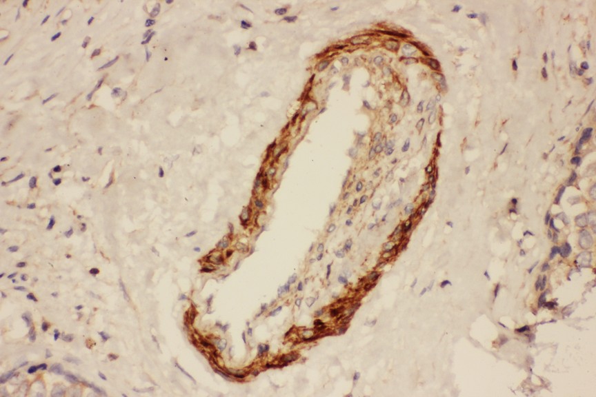 Actin antibody IHC-paraffin: Human Mammary Cancer Tissue.