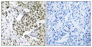 IHC of paraffin-embedded human breast carcinoma tissue, using CAGE1 Antibody. The picture on the right is treated with the synthesized peptide.
