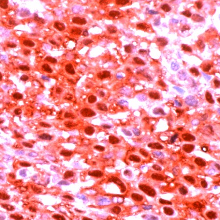 Human mesothelioma stained with anti-Calretinin antibody