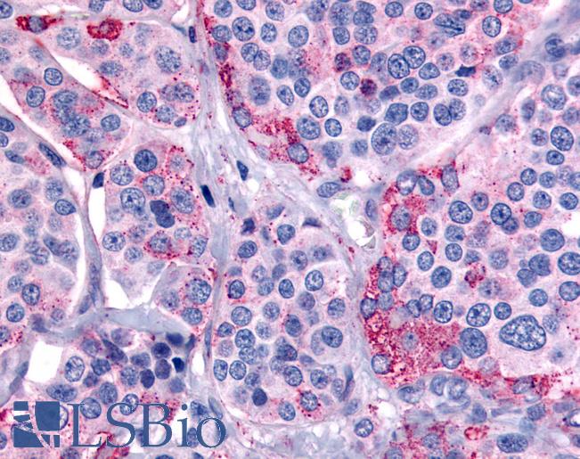 Anti-CALCR / Calcitonin Receptor antibody IHC of human Thyroid, Medullary Carcinoma. Immunohistochemistry of formalin-fixed, paraffin-embedded tissue after heat-induced antigen retrieval.