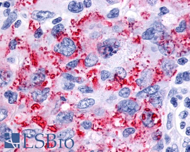 Anti-CALCR / Calcitonin Receptor antibody IHC of human Brain, Glioblastoma. Immunohistochemistry of formalin-fixed, paraffin-embedded tissue after heat-induced antigen retrieval.