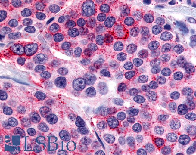 Anti-CALCR / Calcitonin Receptor antibody IHC of human Thyroid, Medullary Carcinoma. Immunohistochemistry of formalin-fixed, paraffin-embedded tissue after heat-induced antigen retrieval.