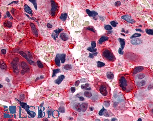 Anti-CALCRL / CGRP Receptor antibody IHC of human Bone, Osteosarcoma. Immunohistochemistry of formalin-fixed, paraffin-embedded tissue after heat-induced antigen retrieval.