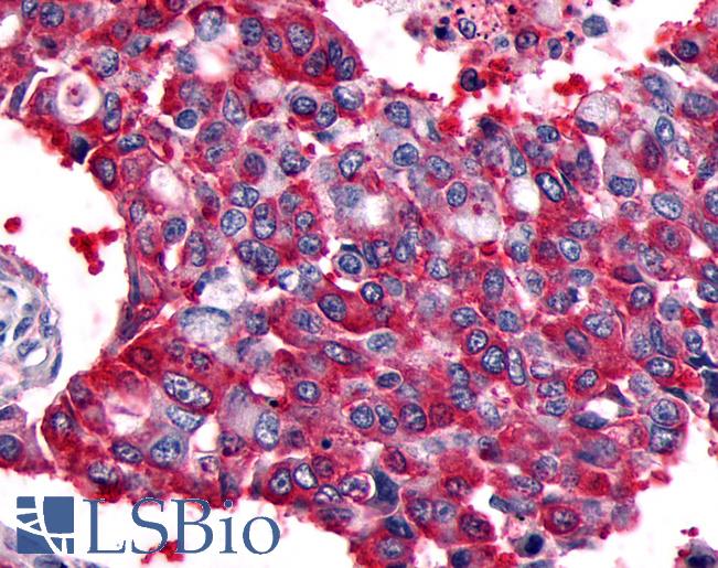 Anti-CALCRL / CGRP Receptor antibody IHC of human Lung, Non-Small Cell Carcinoma. Immunohistochemistry of formalin-fixed, paraffin-embedded tissue after heat-induced antigen retrieval.