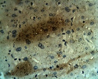 Staining on paraffin embedded human hepatocellular carcinoma sections. Primary Ab at 10 ug/ml. Antigen retrieval used: 10 mM Na Citrate pH 6.0, 10 minutes pressure cooker method, developed with anti rabbit HRP and DAP substrate. Counterstained with methyl blue.