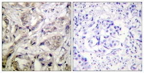 IHC of paraffin-embedded human breast carcinoma tissue, using CaMK1-alpha (Ab-177) Antibody. The picture on the right is treated with the synthesized peptide.
