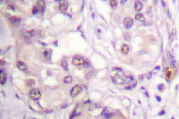 Immunohistochemistry (IHC) analysis of CaMKI alpha (S173) pAb in paraffin-embedded human breast cancer tissue.