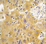 Formalin-fixed and paraffin-embedded human hepatocarcinoma tissue reacted with CAMK1-like Antibody , which was peroxidase-conjugated to the secondary antibody, followed by DAB staining. This data demonstrates the use of this antibody for immunohistochemistry; clinical relevance has not been evaluated.