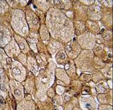 Formalin-fixed and paraffin-embedded human prostate carcinoma tissue reacted with CAMK1G (Center K226) , which was peroxidase-conjugated to the secondary antibody, followed by DAB staining. This data demonstrates the use of this antibody for immunohistochemistry; clinical relevance has not been evaluated.