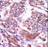 Formalin-fixed and paraffin-embedded human cancer tissue reacted with the primary antibody, which was peroxidase-conjugated to the secondary antibody, followed by AEC staining. This data demonstrates the use of this antibody for immunohistochemistry; clinical relevance has not been evaluated. BC = breast carcinoma; HC = hepatocarcinoma.