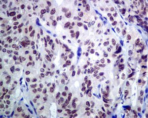 IHC of paraffin-embedded human breast carcinoma tissue using anti-ACTL6 /BAF53 antibody.
