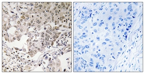 IHC of paraffin-embedded human lung carcinoma, using NCAPG2 Antibody. The picture on the right is treated with the synthesized peptide.