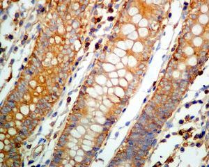 IHC of paraffin-embedded human bladder carcinoma tissue using anti-CAP1 antibody.