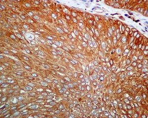 IHC of paraffin-embedded human bladder carcinoma tissue using anti-CAP1 antibody.