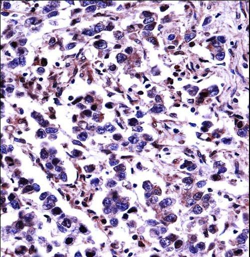 CAPN11 Antibody immunohistochemistry of formalin-fixed and paraffin-embedded human testis carcinoma followed by peroxidase-conjugated secondary antibody and DAB staining.