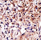 Formalin-fixed and paraffin-embedded human cancer tissue reacted with the primary antibody, which was peroxidase-conjugated to the secondary antibody, followed by DAB staining. This data demonstrates the use of this antibody for immunohistochemistry; clinical relevance has not been evaluated. BC = breast carcinoma; HC = hepatocarcinoma.