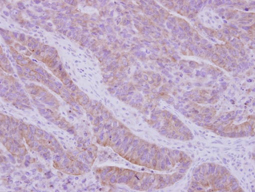 IHC of paraffin-embedded Colon ca, using CARD10 antibody at 1:500 dilution.