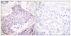IHC of paraffin-embedded human breast carcinoma tissue, using CARD6 Antibody. The picture on the right is treated with the synthesized peptide.