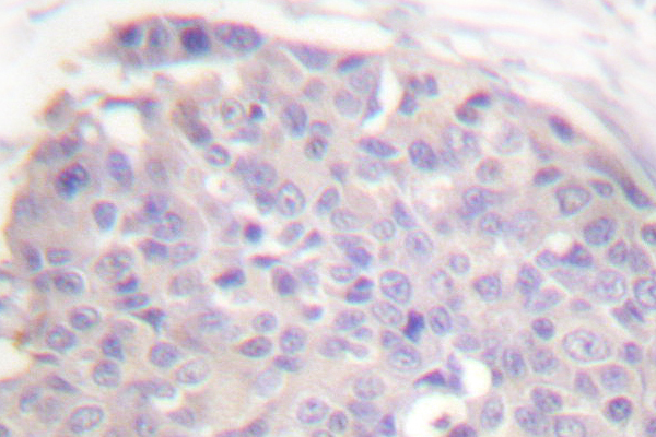 IHC of CARD6/CINCIN1 (A2) pAb in paraffin-embedded human breast carcinoma tissue.