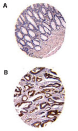 Formalin-fixed, paraffin-embedded human colon tissue sections labeled for TUCAN using LS-C148306 at 1:2000. Hematoxylin-Eosin counterstain. A, normal adjacent colonic epithelium. B, matched malignant colonic epithelium shown in a region of invasive cancer. A and B are from the same colon carcinoma patient.