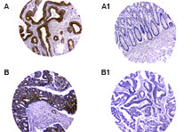 Formalin-fixed, paraffin-embedded tumor/normal adjacent tissue cores from a human colontissue microarray stained for TUCAN/CARD8 expression at 1:2000 using LS-C148305. A and B are tumor tissue cores. A1 and B1 are the matched normal adjacent cores from A and B, respectively. Hematoxylin-Eos in counterstain.