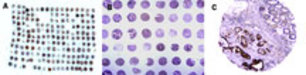 Formalin-fixed, paraffin-embedded tissue human colon microarray stained for TUCAN/CARD8 expression at 1:2000 using LS-C148305. A-A2, successively higher magnifications of the microarray. A, low magnification over view. A1, differential TUCAN/CARD8 staining between tissue cores is observed. A2, Areas of intense TUCAN/CARD8 staining in a colon carcinoma tissue core. Hematoxylin Eosin counterstain.