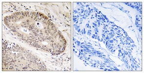 IHC of paraffin-embedded human lung carcinoma tissue, using ALS2CR8 Antibody. The picture on the right is treated with the synthesized peptide.