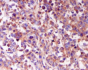 IHC of paraffin-embedded human breast carcinoma tissue using anti-CARS antibody.