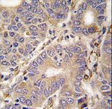 Formalin-fixed and paraffin-embedded human hepatocarcinoma tissue reacted with CARS2 antibody , which was peroxidase-conjugated to the secondary antibody, followed by DAB staining. This data demonstrates the use of this antibody for immunohistochemistry; clinical relevance has not been evaluated.