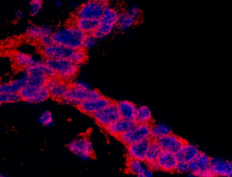 Detection of Human CASC3 by Immunohistochemistry. Sample: FFPE section of human ovarian carcinoma. Antibody: Affinity purified rabbit anti-CASC3 used at a dilution of 1:200 (1 ug/ml).