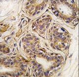 Formalin-fixed and paraffin-embedded human breast carcinoma tissue reacted with CASC3 Antibody (Y181) , which was peroxidase-conjugated to the secondary antibody, followed by DAB staining. This data demonstrates the use of this antibody for immunohistochemistry; clinical relevance has not been evaluated.