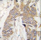 Formalin-fixed and paraffin-embedded human breast carcinoma tissue reacted with CASC3 Antibody , which was peroxidase-conjugated to the secondary antibody, followed by DAB staining. This data demonstrates the use of this antibody for immunohistochemistry; clinical relevance has not been evaluated.