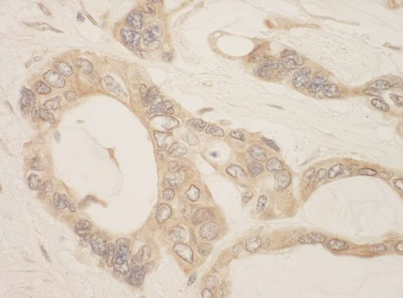 Detection of Human CASC3 by Immunohistochemistry. Sample: FFPE section of human ovarian carcinoma. Antibody: Affinity purified rabbit anti-CASC3 used at a dilution of 1:1000 (1 ug/ml).