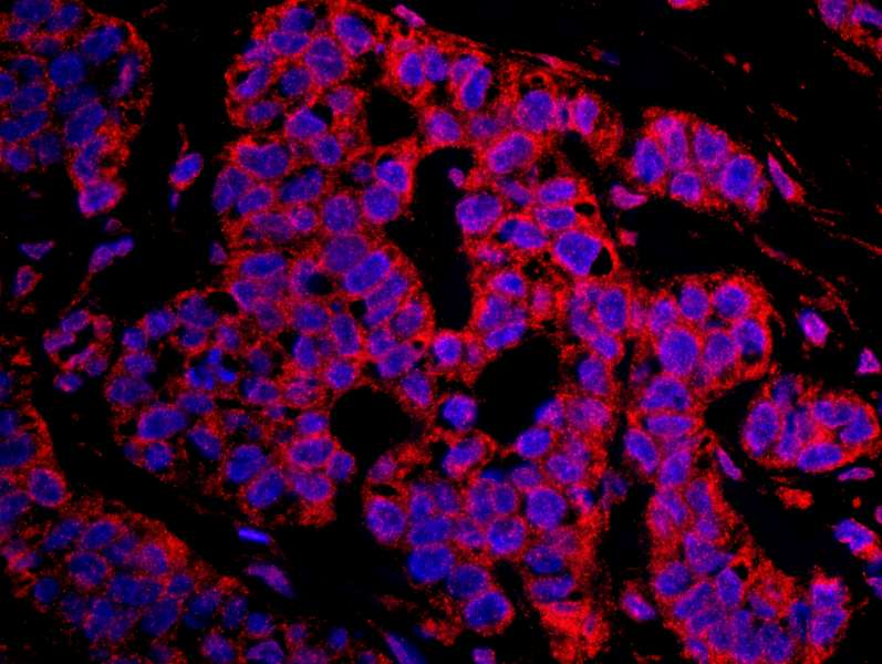 Detection of Human CASC3 by Immunohistochemistry. Sample: FFPE section of human breast carcinoma. Antibody: Affinity purified rabbit anti-CASC3 used at a dilution of 1:100. Detection:Red-fluorescent Goat anti-Rabbit IgG-heavy and light chain cross-adsorbed Antibody DyLight 594 Conjugated (A120-601D4) used at a dilution of 1:100.