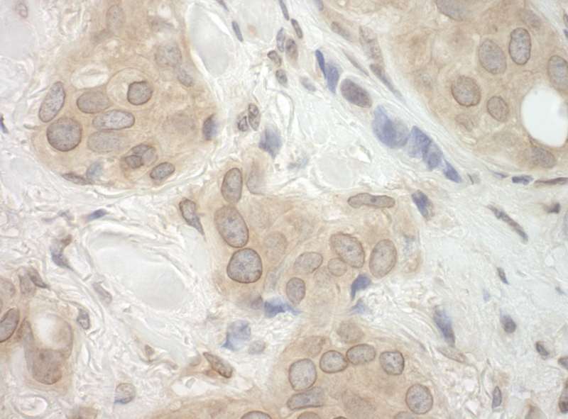 Detection of Human CASC3 by Immunohistochemistry. Sample: FFPE section of human breast carcinoma. Antibody: Affinity purified rabbit anti-CASC3 used at a dilution of 1:250.