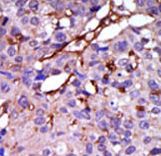Formalin-fixed and paraffin-embedded human cancer tissue reacted with the primary antibody, which was peroxidase-conjugated to the secondary antibody, followed by DAB staining. This data demonstrates the use of this antibody for immunohistochemistry; clinical relevance has not been evaluated. BC = breast carcinoma; HC = hepatocarcinoma.