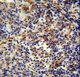 CASKIN2 antibody immunohistochemistry of formalin-fixed and paraffin-embedded human lung carcinoma followed by peroxidase-conjugated secondary antibody and DAB staining.