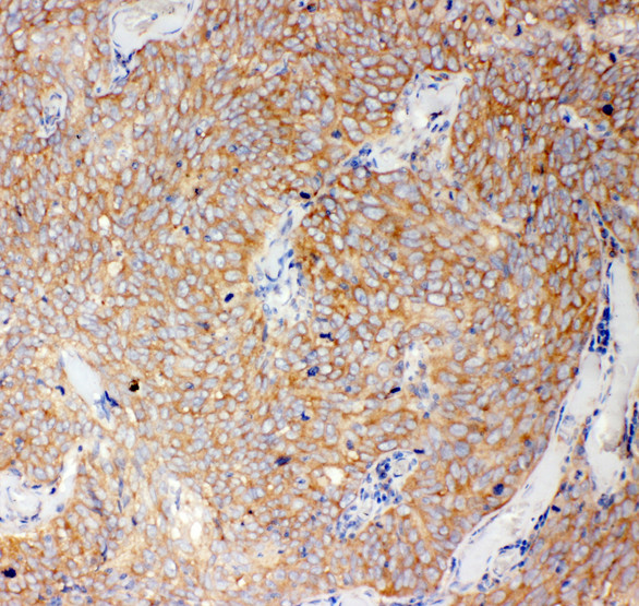 CASP12 / Caspase 12 antibody. IHC(P): Human Lung Cancer Tissue.