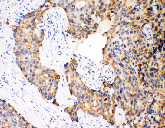 CASP12 / Caspase 12 antibody. IHC(P): Human Breast Cancer Tissue.