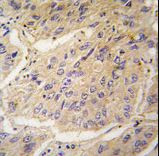 Formalin-fixed and paraffin-embedded human lung carcinoma tissue reacted with CASP3 antibody , which was peroxidase-conjugated to the secondary antibody, followed by DAB staining. This data demonstrates the use of this antibody for immunohistochemistry; clinical relevance has not been evaluated.