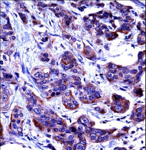 CASP6 Antibody immunohistochemistry of formalin-fixed and paraffin-embedded human bladder carcinoma followed by peroxidase-conjugated secondary antibody and DAB staining.